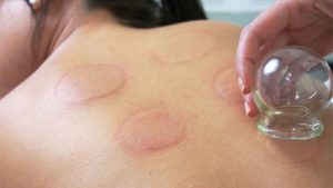 close up of person receiving cupping massage that shows the red marks left behind by the cups